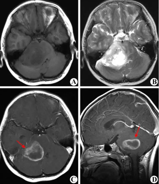 日本治疗儿童脑干神经胶质瘤患者案例