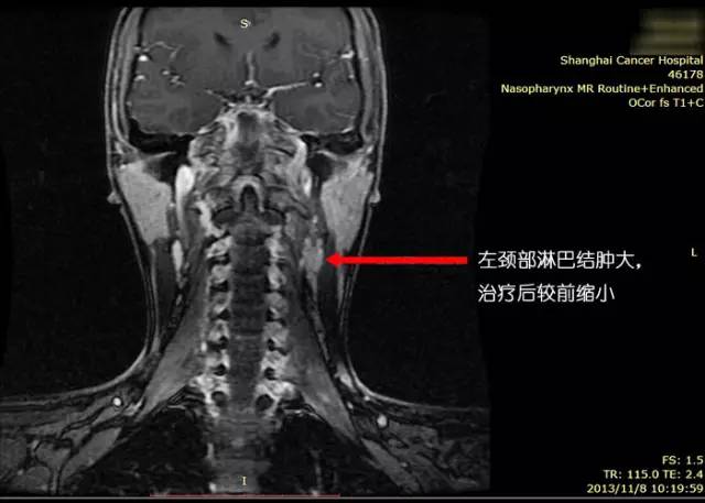 鼻咽癌复发